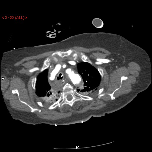 Aortic intramural hematoma (Radiopaedia 27746-28001 A 22).jpg
