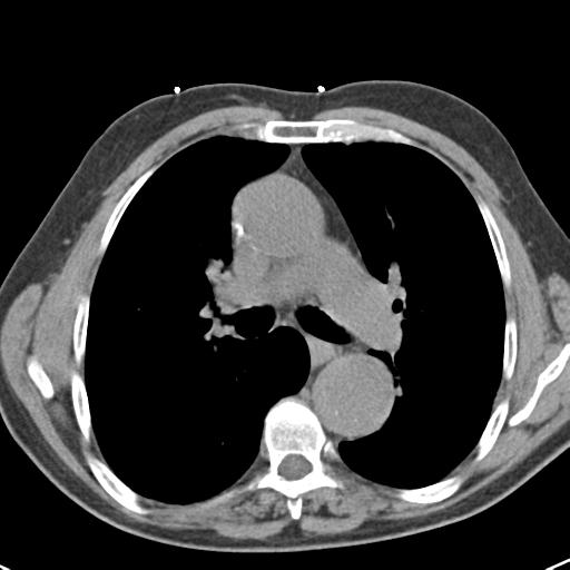 File:Aortic intramural hematoma (Radiopaedia 31139-31838 Axial non-contrast 24).jpg