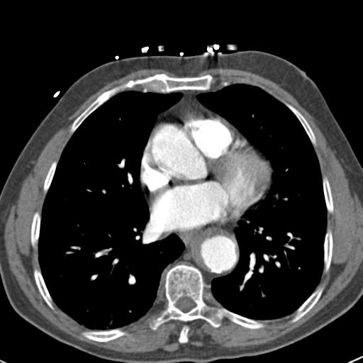 Aortic intramural hematoma (Radiopaedia 31139-31838 B 54).jpg