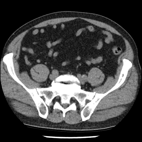 Aortic intramural hematoma (type B) (Radiopaedia 79323-92387 Axial non-contrast 92).jpg