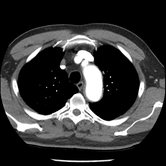 Aortic intramural hematoma (type B) (Radiopaedia 79323-92387 B 11).jpg
