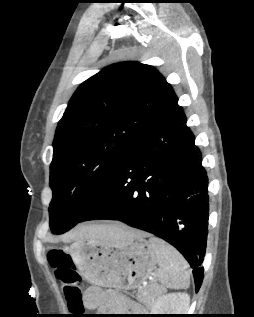 Aortic valve non-coronary cusp thrombus (Radiopaedia 55661-62189 D 12).png