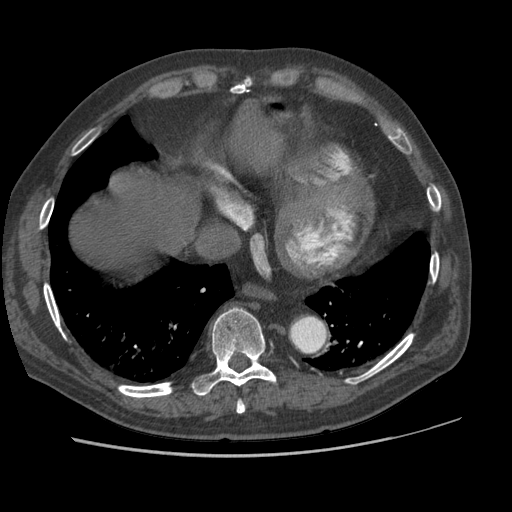 File:Aorto-coronary bypass graft aneurysms (Radiopaedia 40562-43157 A 94).png
