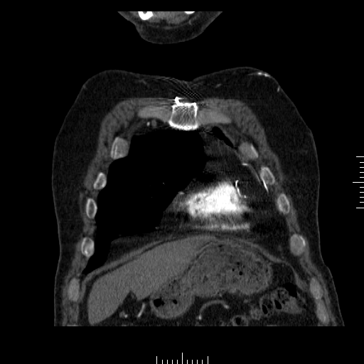 File:Aorto-coronary bypass graft aneurysms (Radiopaedia 40562-43157 B 6).png