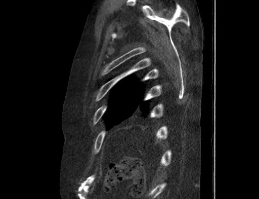 Aortoesophageal fistula with endovascular repair (Radiopaedia 73781-84592 Sagittal C+ CTPA 181).jpg