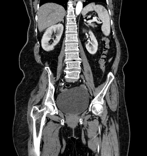 Aortoiliac occlusive disease (Radiopaedia 52352-58248 B 40).jpg
