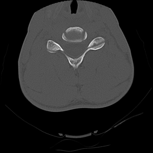Apical pneumothorax on cervical spine CT (Radiopaedia 45343-49368 Axial bone window 55).jpg