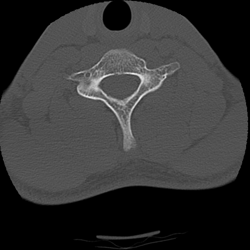 File:Apical pneumothorax on cervical spine CT (Radiopaedia 45343-49368 Axial bone window 68).jpg