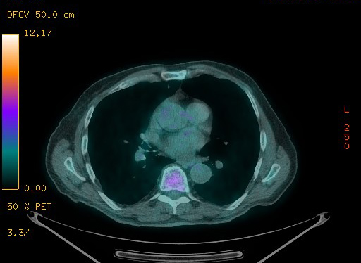 Appendiceal adenocarcinoma complicated by retroperitoneal abscess (Radiopaedia 58007-65041 Axial PET-CT 72).jpg