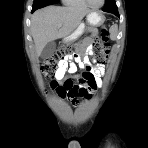 File:Appendicitis complicated by post-operative collection (Radiopaedia 35595-37113 B 16).jpg