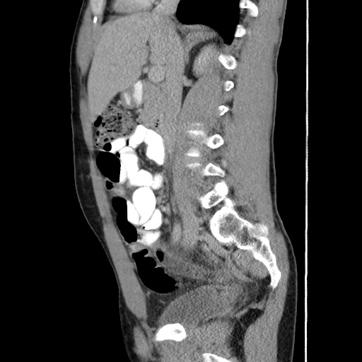 Appendicitis complicated by post-operative collection (Radiopaedia 35595-37114 C 32).jpg