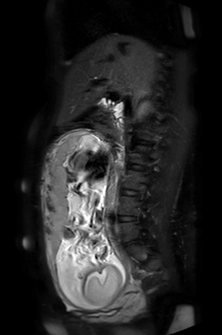 Appendicitis in gravida (MRI) (Radiopaedia 89433-106395 Sagittal T2 SPAIR 35).jpg
