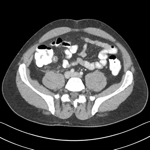 Appendicitis with cecal bar sign (Radiopaedia 31878-32830 B 54).jpg