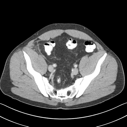 Appendicitis with cecal bar sign (Radiopaedia 31878-32830 B 64).jpg
