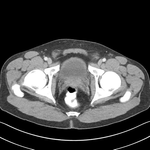 Appendicitis with cecal bar sign (Radiopaedia 31878-32830 B 78).jpg