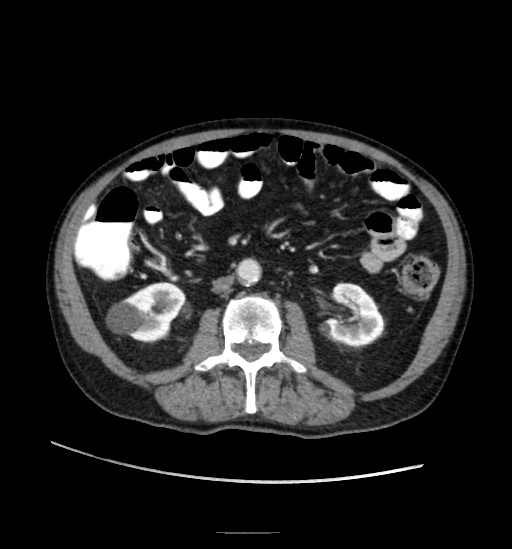 Appendicitis with localized perforation and abscess formation (Radiopaedia 49035-54130 A 45).jpg