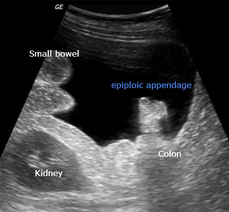 File:Appendix epiploica (Radiopaedia 30827-31540 C 1).jpg