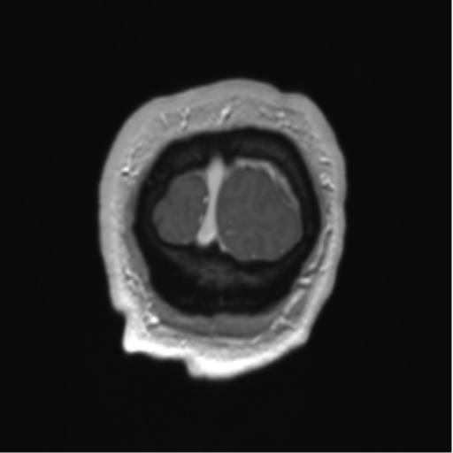 Arachnoid cyst with subdural hematoma (Radiopaedia 85892-101743 Coronal T1 C+ 3).png