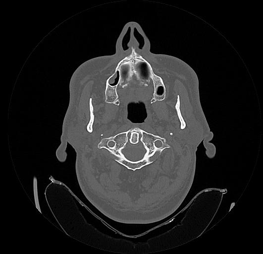 Arcuate foramen (Radiopaedia 89833-106944 Axial bone window 27).jpg