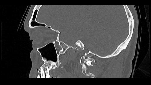Arcuate foramen (Radiopaedia 89833-106944 Sagittal bone window 99).jpg