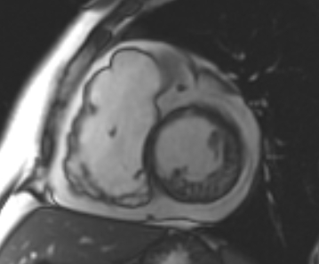 Arrhythmogenic right ventricular cardiomyopathy (Radiopaedia 69431-79307 Short axis cine 143).jpg