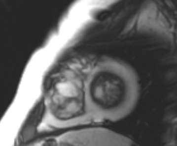 Arrhythmogenic right ventricular cardiomyopathy (Radiopaedia 69431-79307 Short axis cine 26).jpg