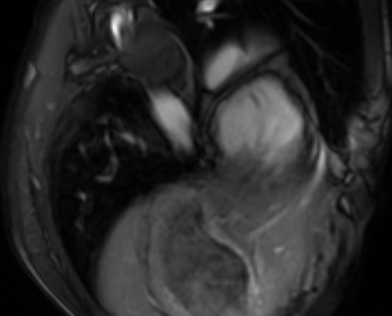 Arrhythmogenic right ventricular cardiomyopathy (Radiopaedia 69564-79464 4ch cine 146).jpg
