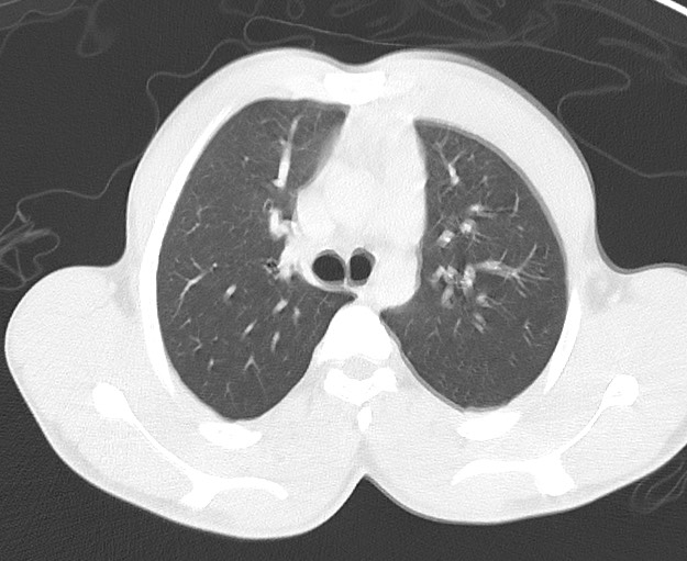 Arrow injury to the chest (Radiopaedia 75223-86321 Axial lung window 20).jpg