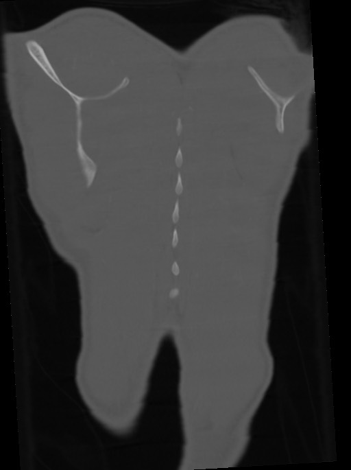 Arrow injury to the neck (Radiopaedia 75225-86323 Coronal bone window 110).jpg
