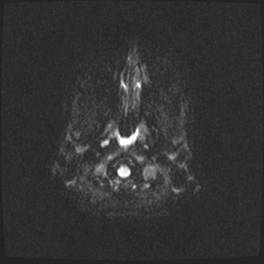 Arteriovenous malformation (Radiopaedia 63693-72385 DWI 21).jpg