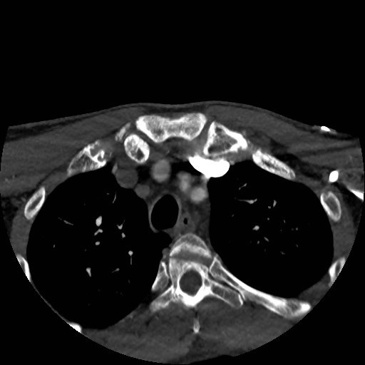 Artery of Percheron infarct (Radiopaedia 48088-52894 A 12).jpg