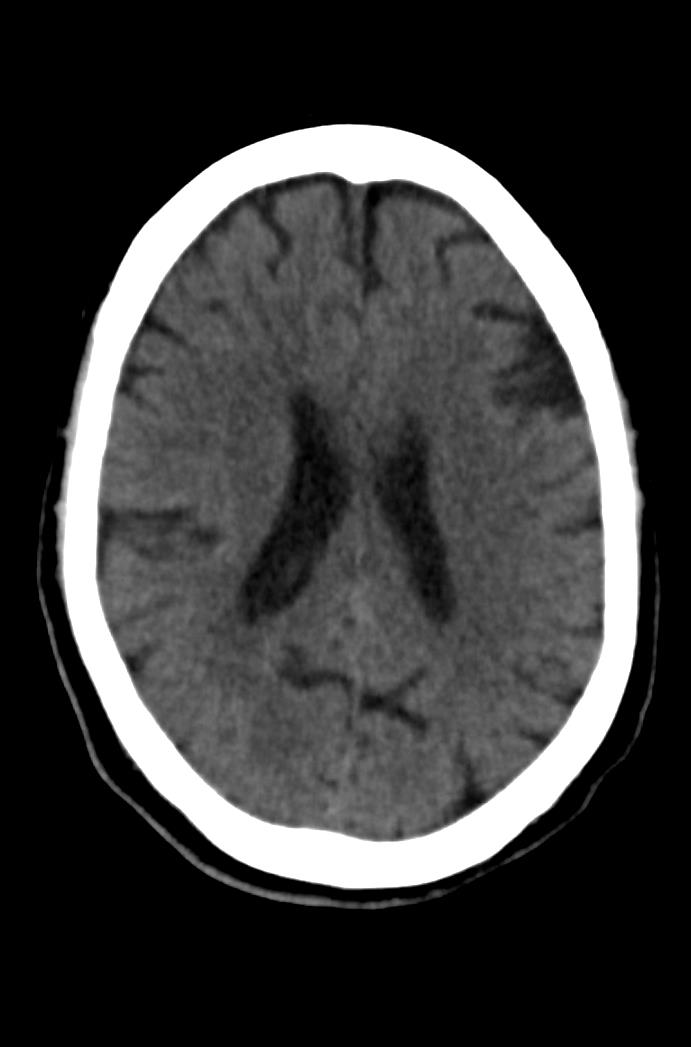 Artery of Percheron infarction (Radiopaedia 80613-94202 Axial non-contrast 121).jpg