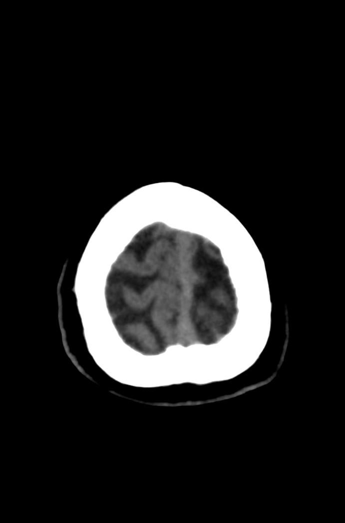 Artery of Percheron infarction (Radiopaedia 80613-94202 Axial non-contrast 179).jpg