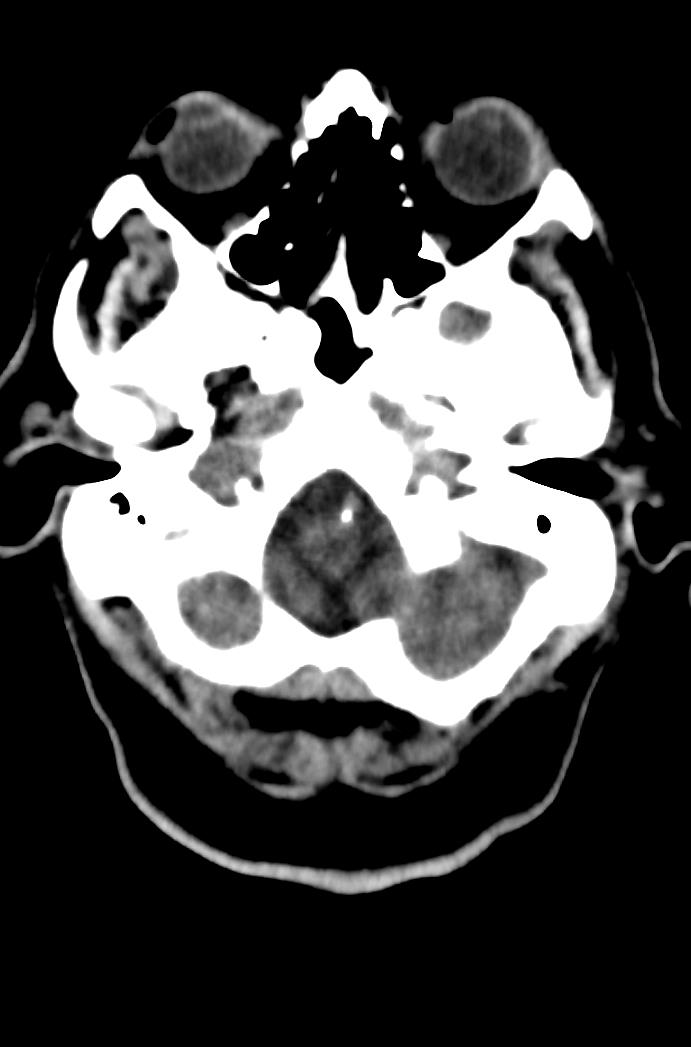 Artery of Percheron infarction (Radiopaedia 80613-94202 Axial non-contrast 36).jpg