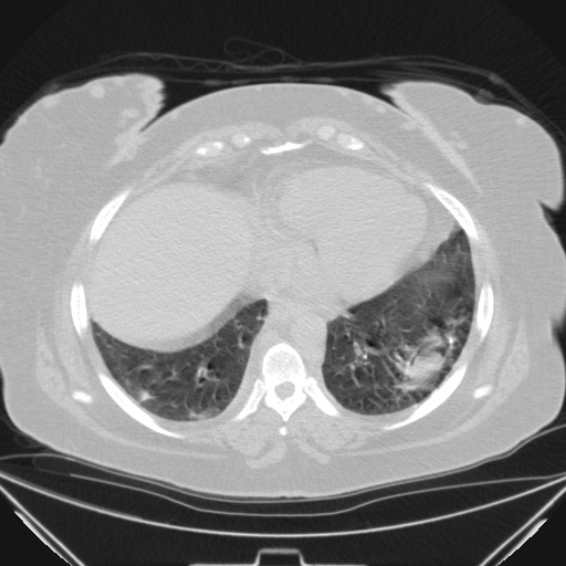 Aspergilloma (Radiopaedia 39611-41932 Axial lung window 97).jpg