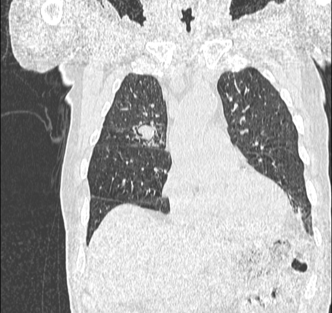 Aspergilloma (Radiopaedia 44592-48327 Coronal lung window 37).jpg