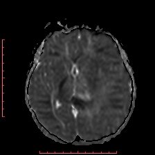 Astroblastoma (Radiopaedia 74287-85162 Axial ADC 32).jpg