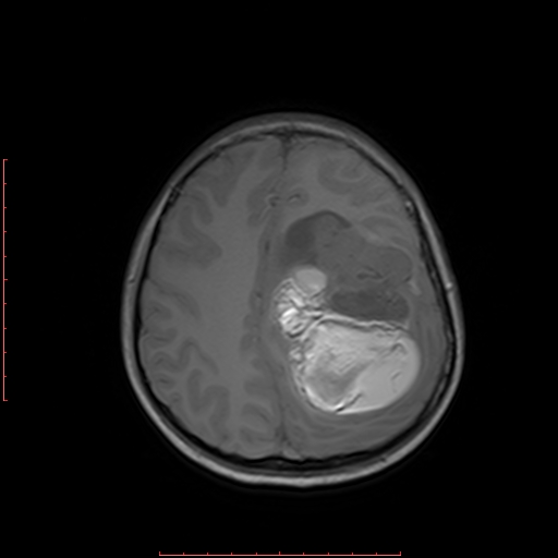 File:Astroblastoma (Radiopaedia 74287-85162 Axial T1 16).jpg