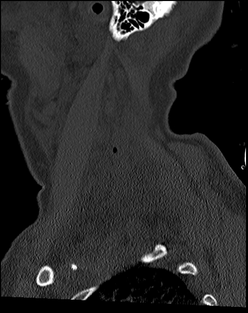 Atlanto-occipital dissociation - Traynelis type 1 (Radiopaedia 87570-103948 Sagittal bone window 71).jpg