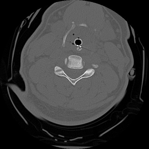 Atlanto-occipital dissociation injury (Radiopaedia 29274-29698 Axial bone window 42).png