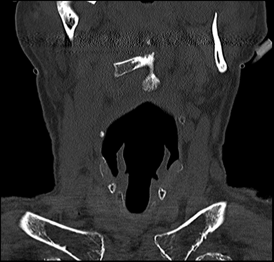 File:Atlas (type 3b subtype 1) and axis (Anderson and D'Alonzo type 3, Roy-Camille type 2) fractures (Radiopaedia 88043-104607 Coronal bone window 13).jpg