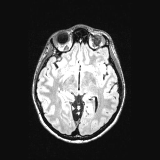 Atretic encephalocoele with inferior vermis hypoplasia (Radiopaedia 30443-31108 Axial 74).jpg