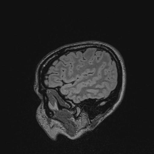 Atretic encephalocoele with inferior vermis hypoplasia (Radiopaedia 30443-31108 Sagittal FLAIR 36).jpg