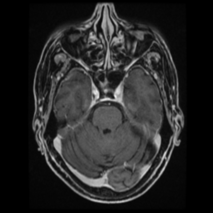 Atypical meningioma (Radiopaedia 45535-49629 Axial T1 C+ 28).jpg