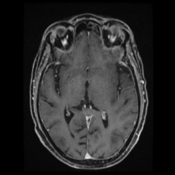Atypical meningioma (Radiopaedia 45535-49629 Axial T1 C+ 37).jpg