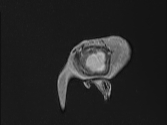 Atypical meningioma (Radiopaedia 62985-71406 Sagittal T1 C+ 106).jpg