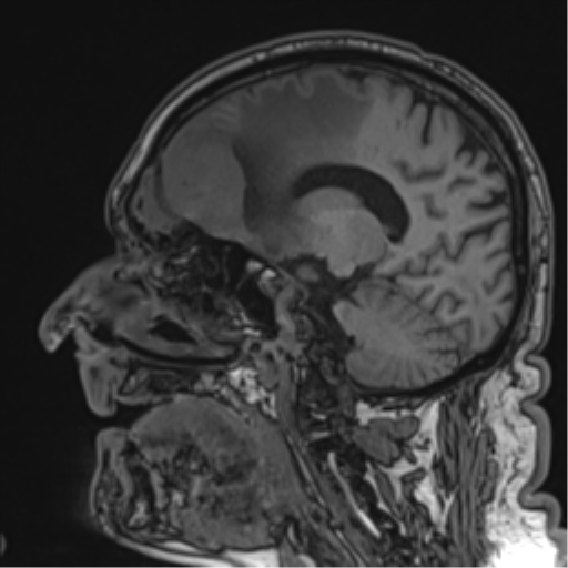 Atypical meningioma (WHO grade II) with brain invasion (Radiopaedia 57767-64729 Sagittal T1 41).png