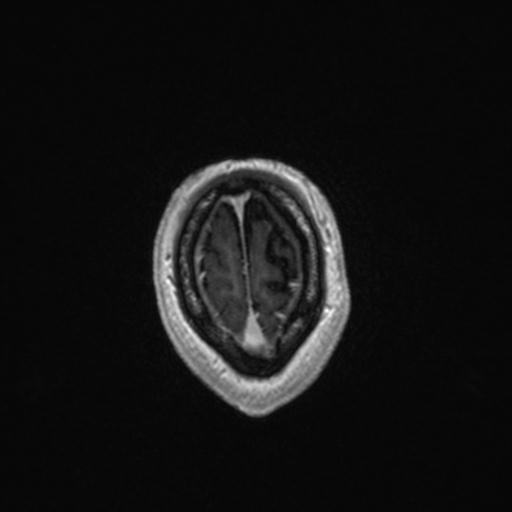Atypical meningioma (grade II) - en plaque (Radiopaedia 29633-30147 Axial T1 C+ 165).jpg