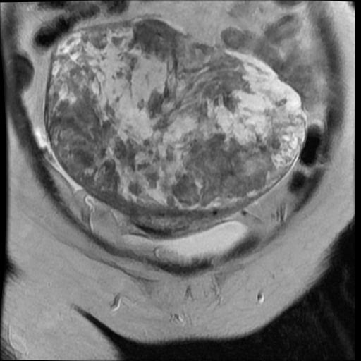 File:Atypical retroperitoneal lymphocoeles with large leiomyoma of uterus (Radiopaedia 32084-33027 Coronal T2 7).jpg