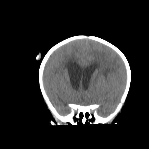 Atypical teratoid rhabdoid tumor (AT-RT) (Radiopaedia 85823-101654 Coronal non-contrast 19).jpg